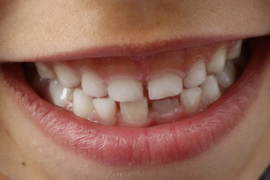 अकल दाढ़ किसे कहते हैं | अकल दाढ़ क्या है | What is a wisdom tooth in hindi